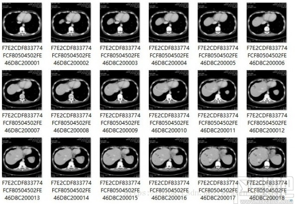 MicroDicom viewer(Dicom格式看图软件)