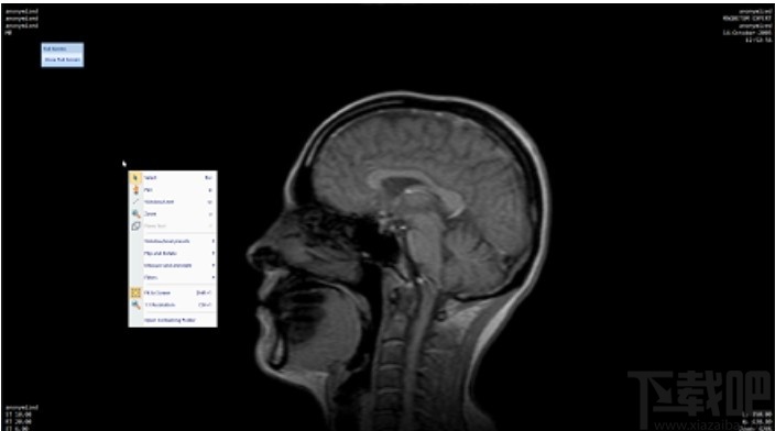 MicroDicom viewer(Dicom格式看图软件)